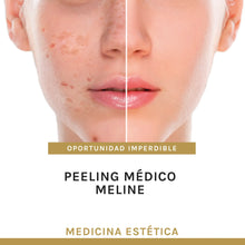 Cargar imagen en el visor de la galería, Peeling médico MELINE